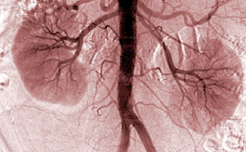 Image: X-ray of human kidneys (Photo courtesy of the University of California, San Diego School of Medicine).